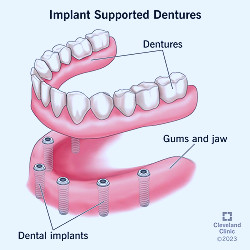 Implant Supported Dentures: Process, Benefits & Care